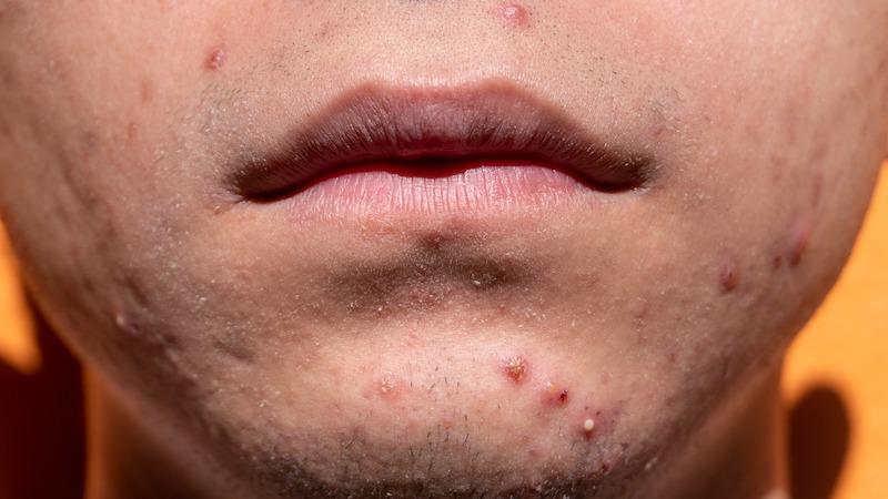 Acne: Origin, Causes, Precautions And Treatment – OpEd