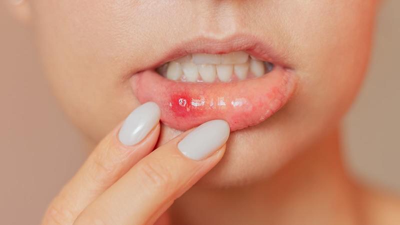 My mother is plagued by mouth ulcers - can we find her a remedy?